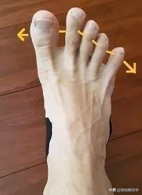 足踝稳定性差应该怎么练,扁平足怎么锻炼脚踝力量