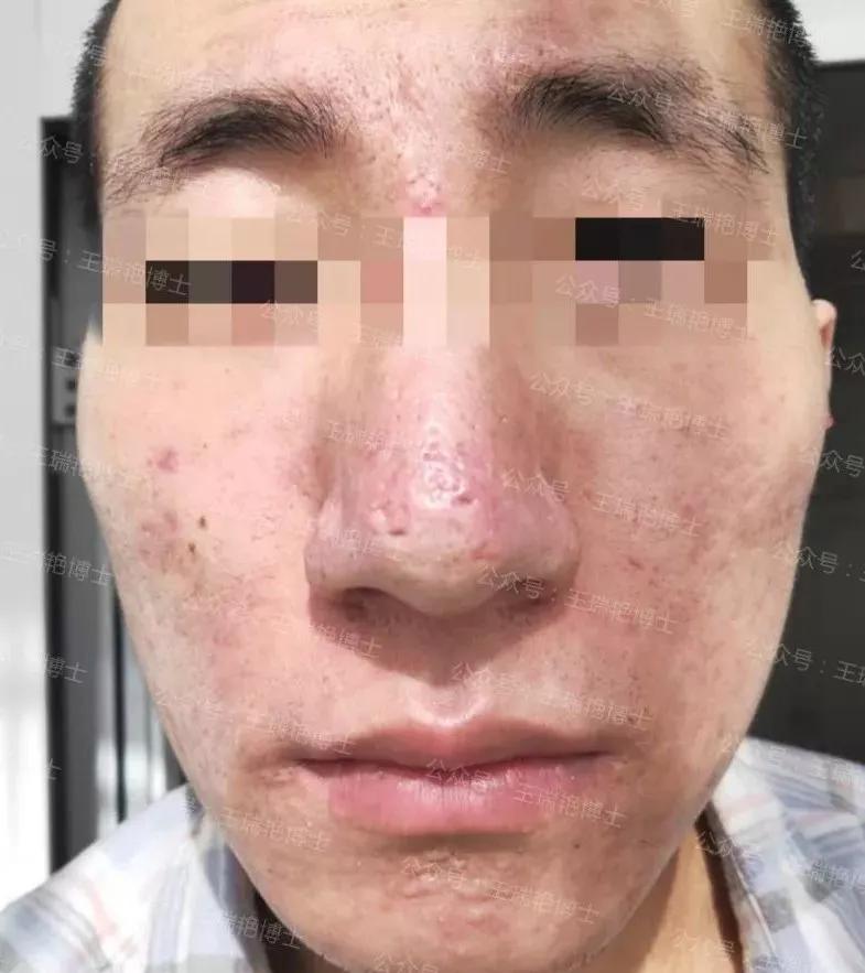 魔幻案例:出身医学世家,却靠求神拜佛来治疗痘痘