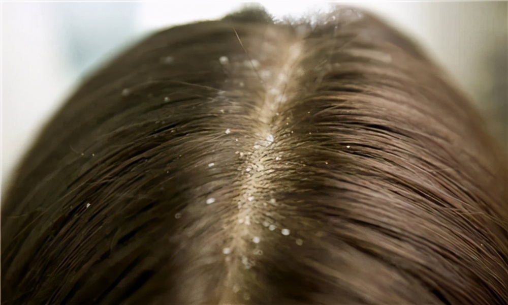 头皮屑为什么让人烦,头皮屑跟心情有关