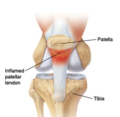 为什么跑跳之后膝盖不舒服,跑跳或者蹲下小腿疼