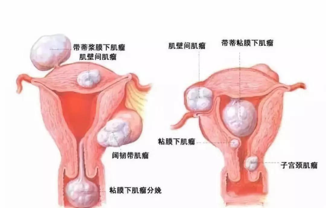 专家讲治疗子宫肌瘤的方法,微创介入子宫肌瘤栓塞术