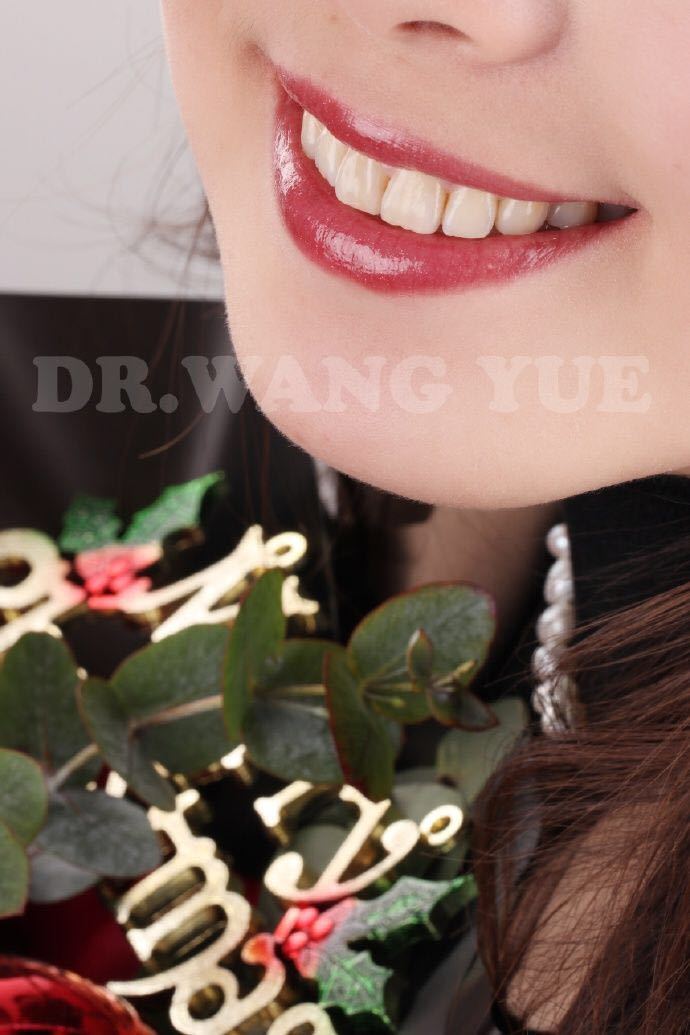 牙齿美学修复的缺点,大龄牙齿矫正经历和感受