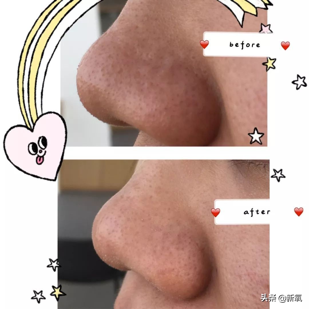 五分钟教你有效去黑头,最火去黑头收缩毛孔