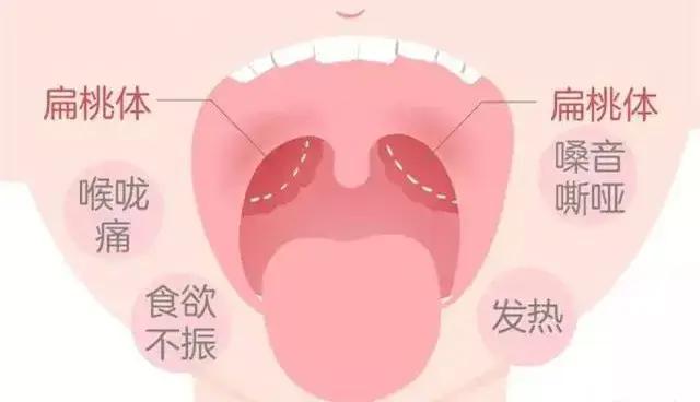 孩子扁桃体化脓反复中医怎么说,扁桃体反复化脓怎么调理能根除