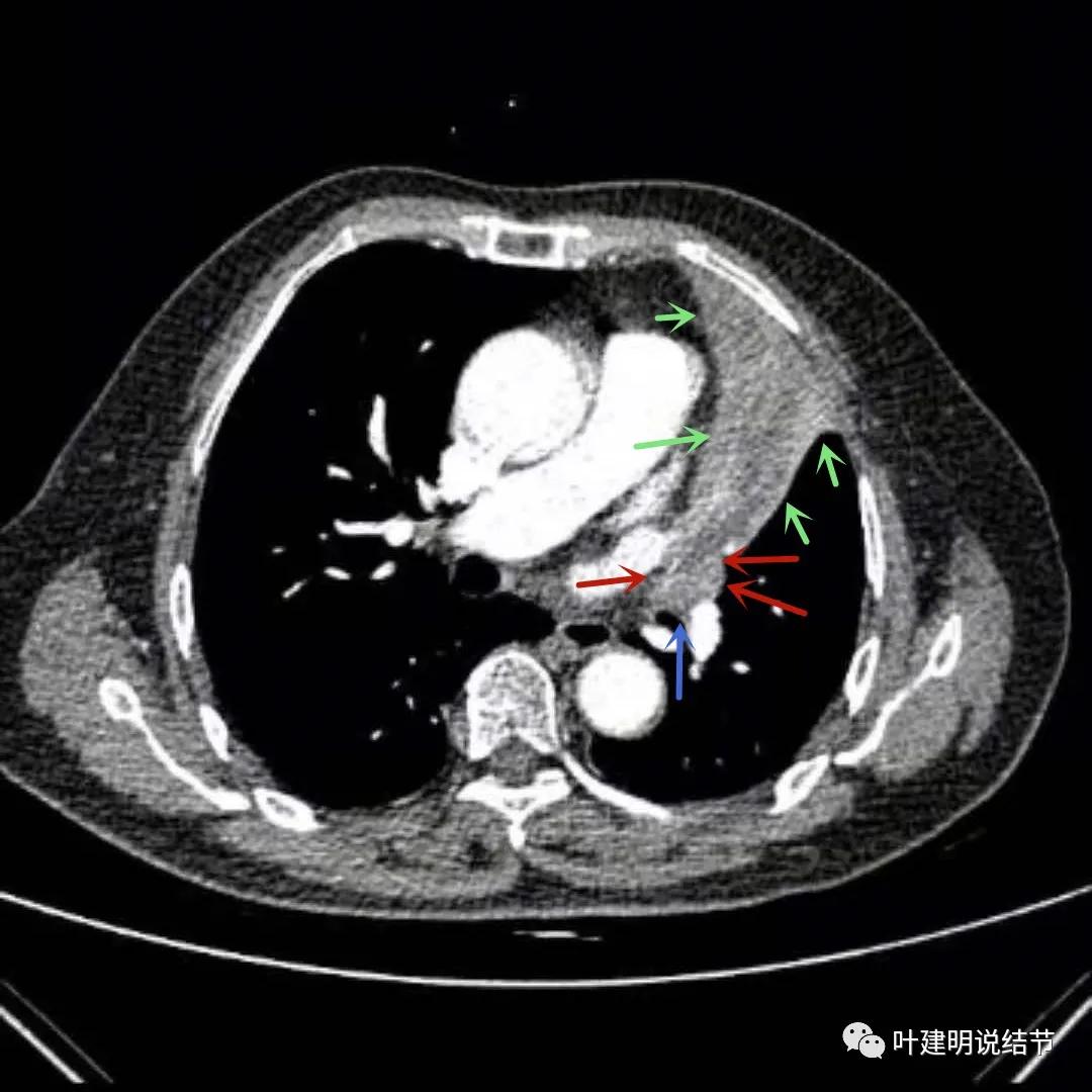 高龄肺癌靶向治疗效果,高龄老人肺癌早期适合放疗吗