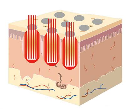 脸颊毛孔变粗有办法解救吗,脸颊器质性毛孔粗大