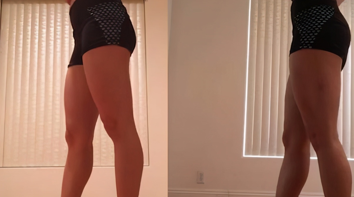 大腿太粗走路内侧磨红怎么办,大腿内侧磨腿怎么解决