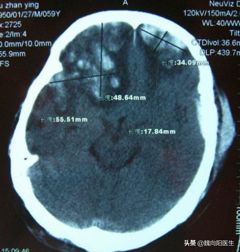后脑勺着地很危险的,为什么后脑勺着地危害大