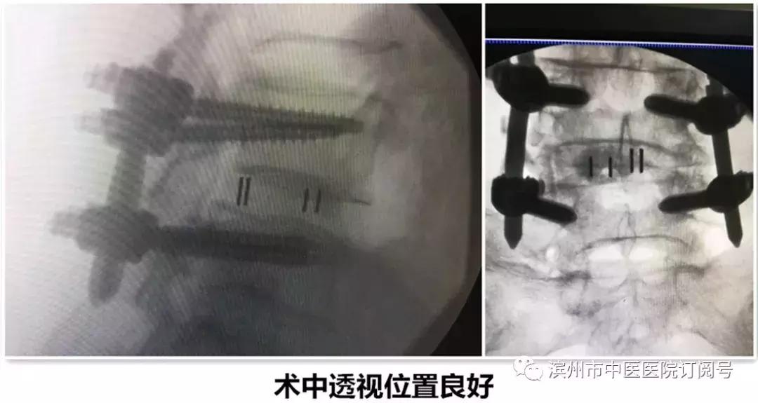 椎间盘突出保守治疗,椎间盘治疗视频大全