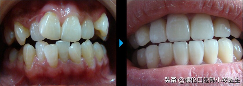 儿童牙齿拥挤矫正方法视频,换牙牙齿拥挤该如何矫正
