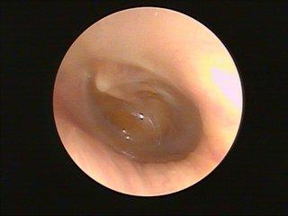 儿童中耳炎吃的怎么是鼻窦炎的药,儿童分泌性中耳炎的外科治疗指征