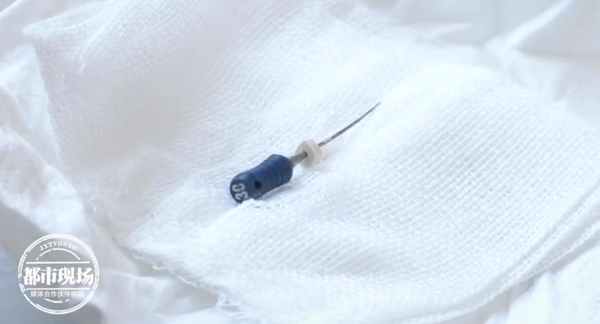 男子治牙结果4厘米针头掉进气管几天后他开始不停咳嗽