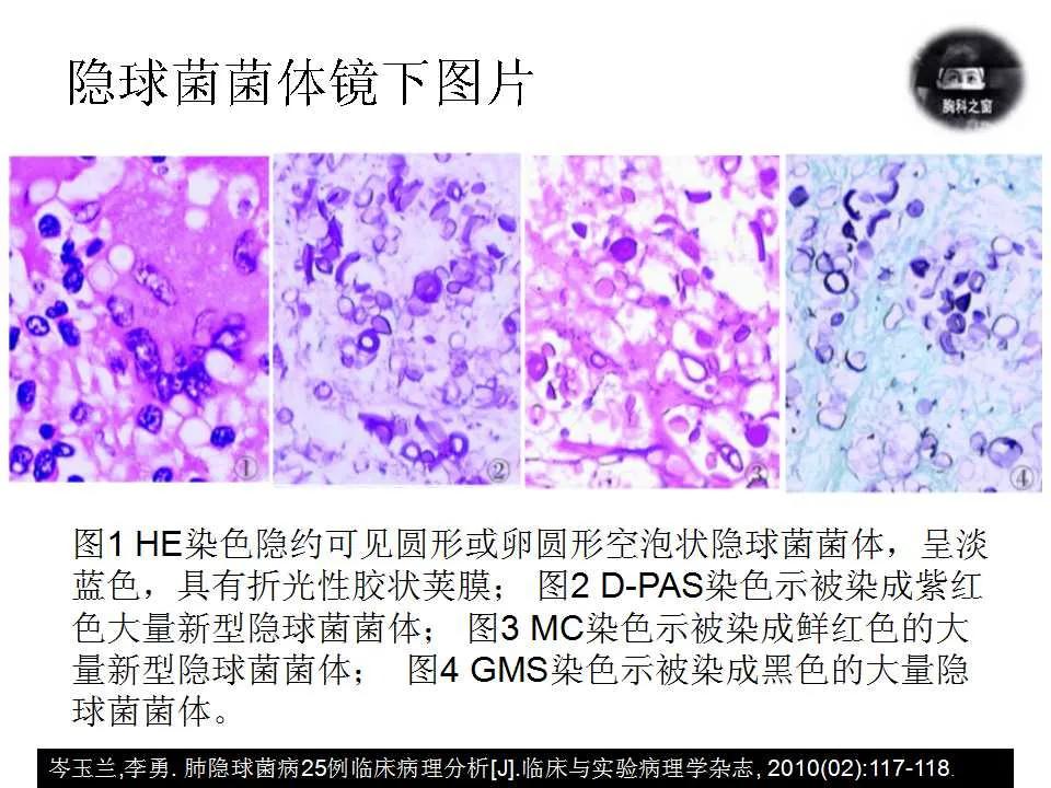 双肺多发结节是肺癌的征兆吗,双肺多发结节灶