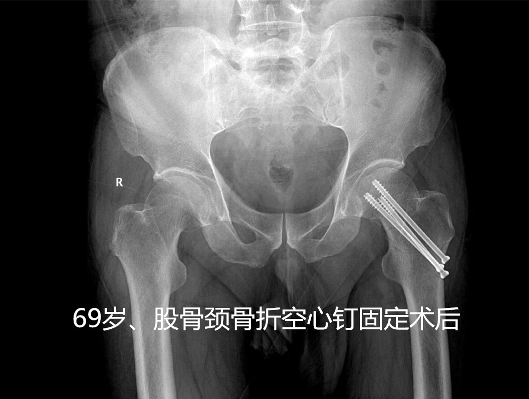 人生最后一次骨折有必要手术吗,人生的最后一次骨折指哪个部位