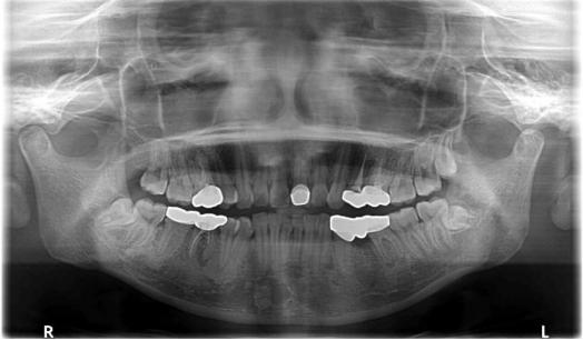 烤瓷冠连着做和单做有什么区别,烤瓷牙矫正成功案例