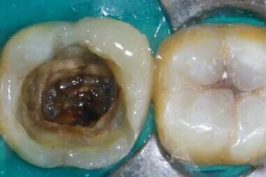蛀牙不补能不能戴牙套,蛀牙不补认真刷牙可以防止变严重吗