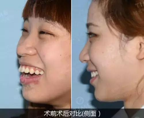 30岁龅牙矫正大概要花费多少钱,30岁龅牙还能做牙齿矫正吗