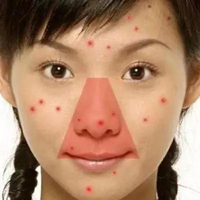 挤痘进入icu,随手挤了个痘痘