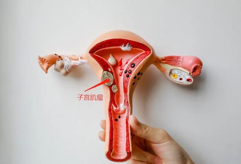 超声介入治疗子宫肌瘤的方法,上海超声波定位介入治疗子宫肌瘤