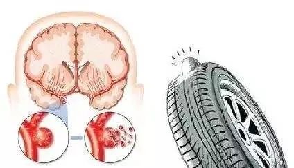 颅内动脉瘤需要放支架吗,颅内动脉瘤夹闭术手术步骤