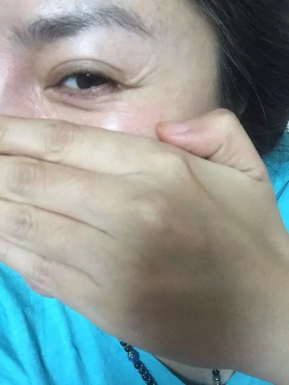 41岁考虑线雕和拉皮哪个好,线雕40岁后的感受