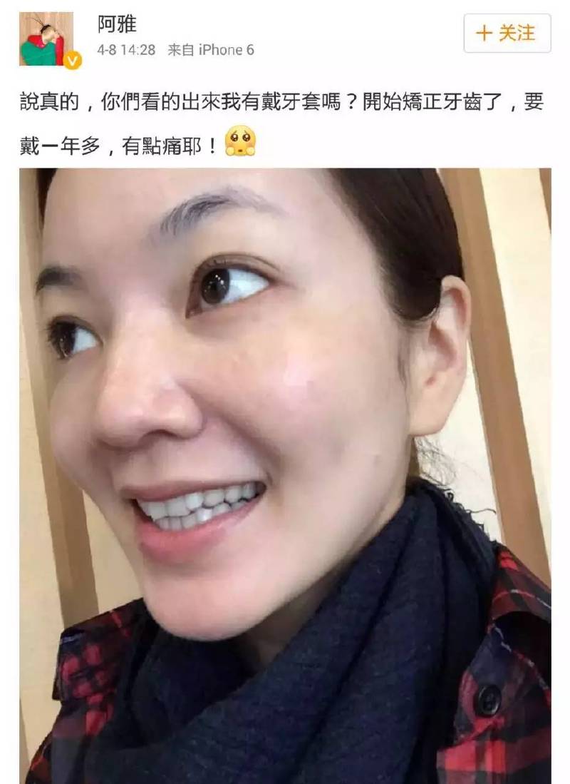 吴宣仪烤瓷牙怎么做,吴宣仪的整牙前