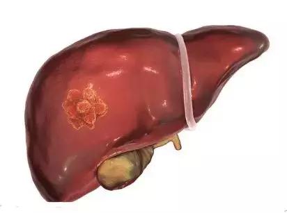 发现肝脏结节要做哪些检查,发现肝部有小结节用治疗吗