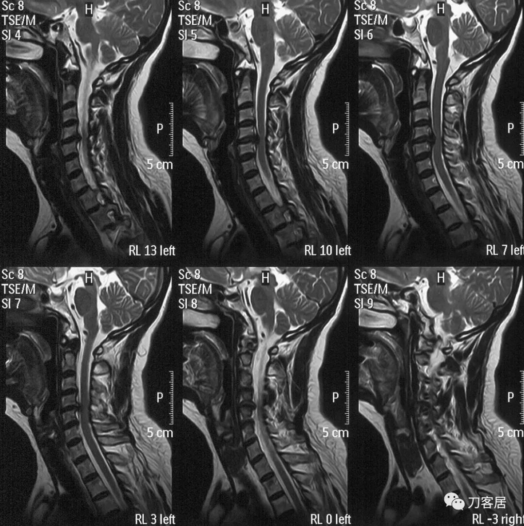 脊髓型颈椎病手术后多少天能出院,脊髓型颈椎病手术几天出院