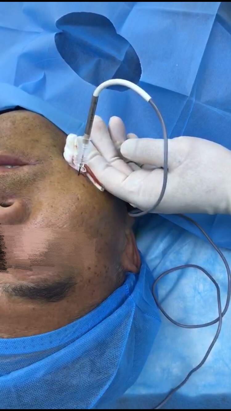 如果牙痛是三叉神经痛怎么治疗,三叉神经痛引起的牙痛怎么办