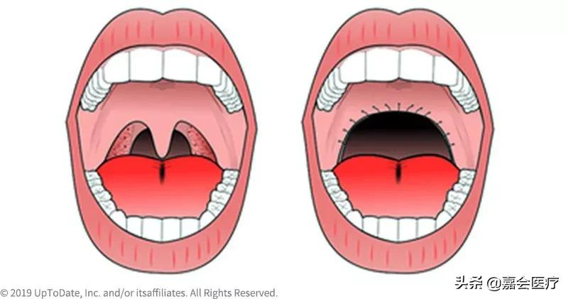 治好打鼾其实很简单的,通过手术能彻底治好打鼾吗