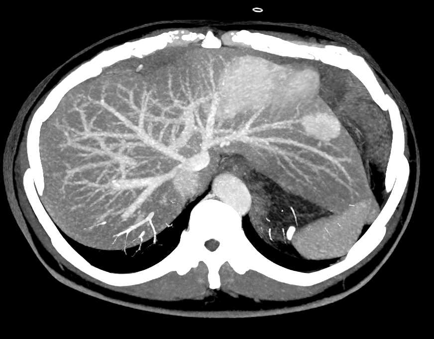 为什么肝血管瘤医生建议不用管,有了肝血管瘤要注意什么