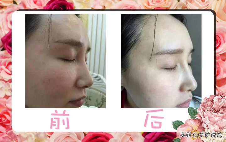 光子嫩肤后怎么快速美白,光子嫩肤和光子美白