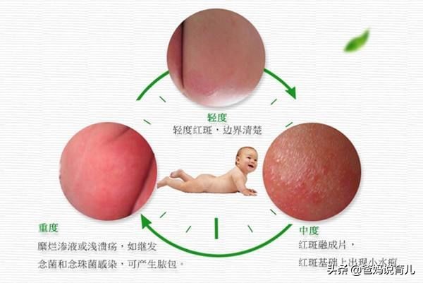 宝宝反复红屁股？医生教你如何护理