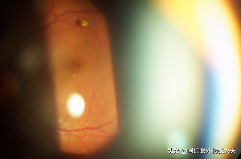 七类眼外伤急救知识,严重眼外伤后注意事项