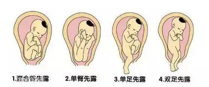 胎位不正每天趴多久,胎位不正几周可以人工倒转