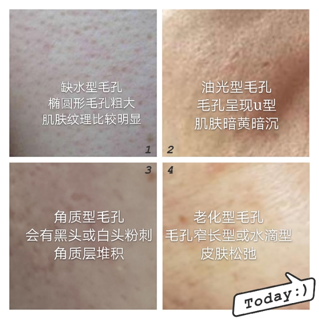 鼻头毛孔粗大如何改善缩小毛孔,毛孔粗大如何改善最有效的方法