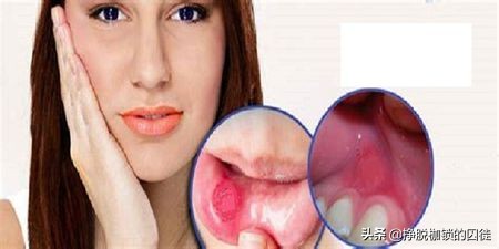 菠萝为什么上火,吃菠萝为啥容易长痘