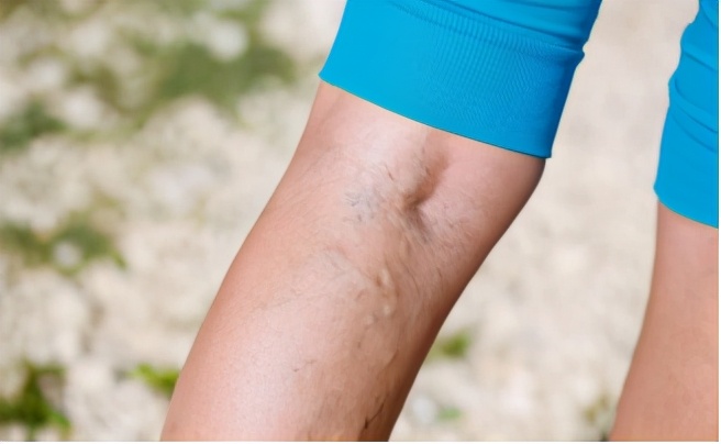 血管外科静脉曲张治疗,静脉曲张引起血管瘤如何治疗