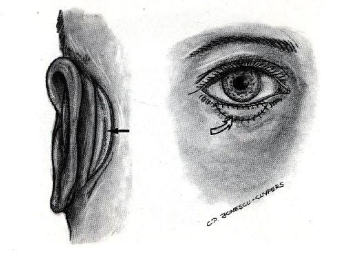 眼皮出现黄斑要警惕,眼皮上有异物怎么处理