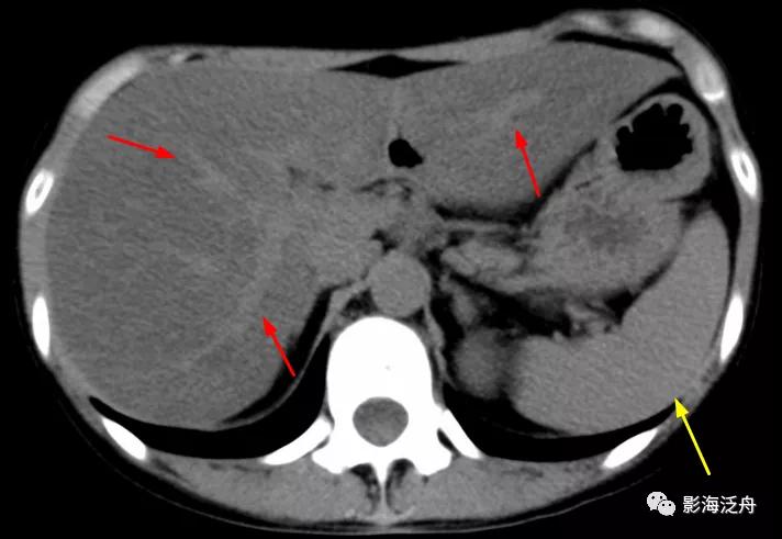 肝脏弥漫性病变严重吗,肝脏弥漫性的病变的症状