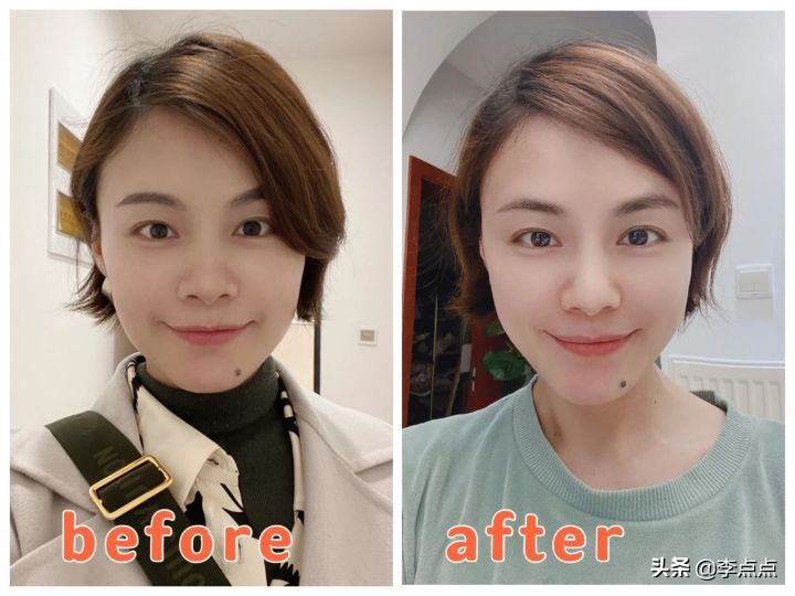 熬夜写完了医美后续，美真的是要付出代价的