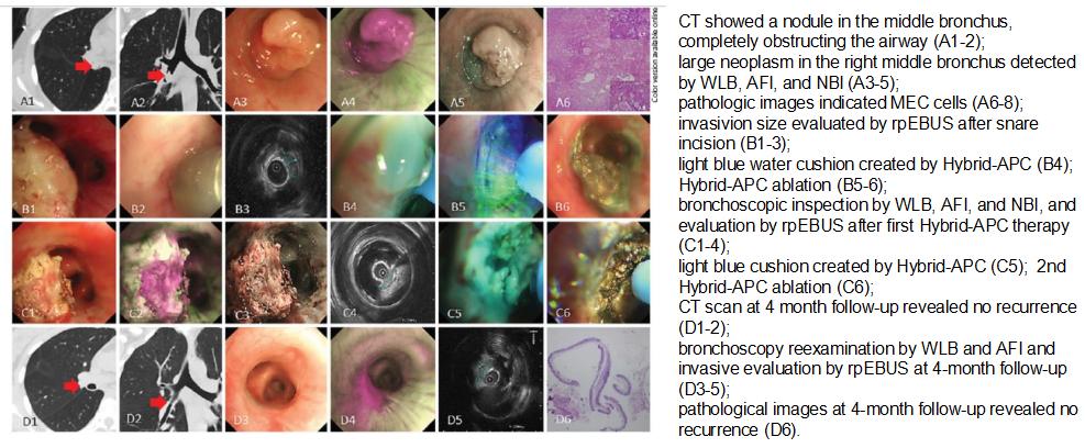 小细胞肺癌的气管镜介入治疗,导航支气管镜在肺癌诊断中的应用