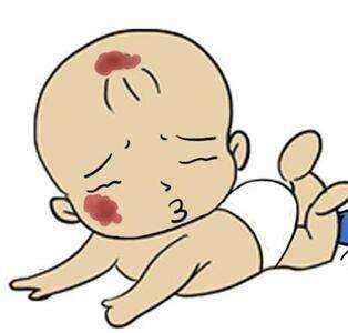 专家讲解血管瘤和血管畸形,医生支招血管瘤并发症的处理