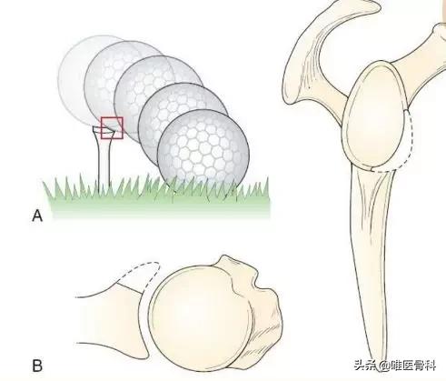 习惯性脱臼患者,习惯性脱臼一动就掉