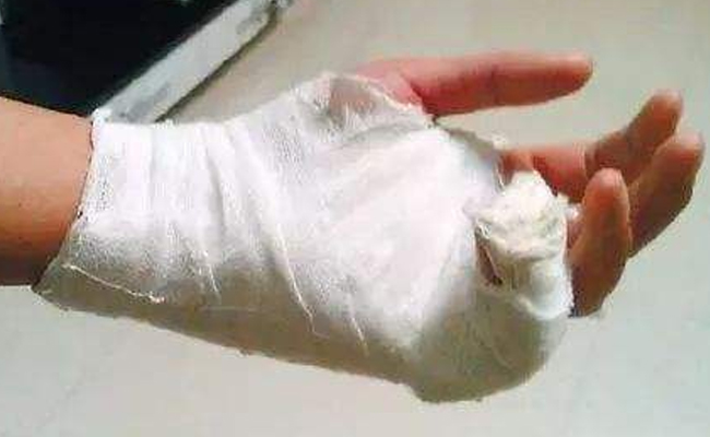 澳洲疤痕修复方法,澳洲疤痕怎么消除