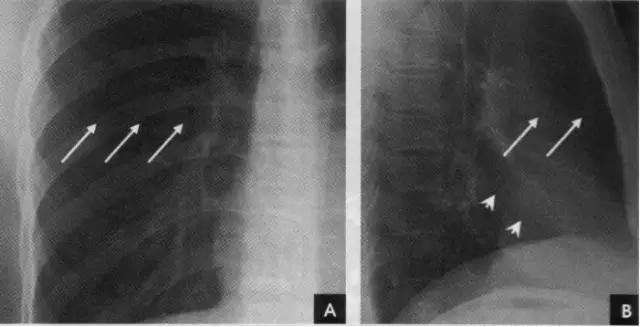 收藏：详细的胸部X线解剖，最基础最实用