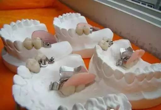 烤瓷牙的危害与副作用,全烤瓷牙有什么风险和后遗症