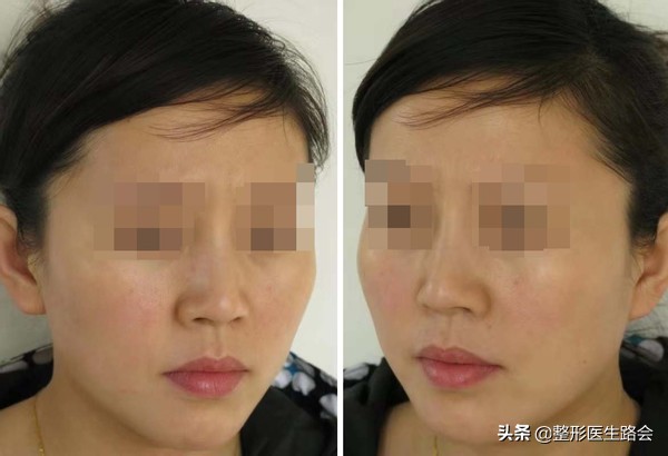 隆下巴硅胶和膨体哪个好,膨体隆下巴和硅胶隆下巴区别