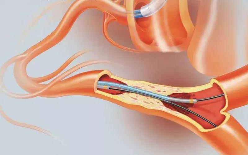 走近肿瘤的介入治疗