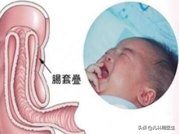 宝宝肠绞痛会哭一整天吗,新生儿怎么区分肠绞痛还是肠套叠